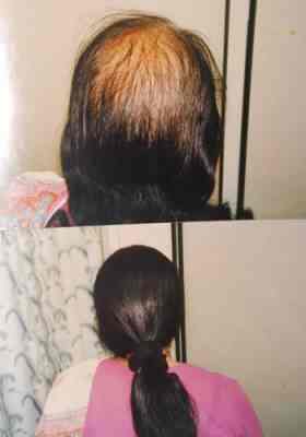 Top Hair Weaving Services In Narol Ahmedabad Fix Your Baldness