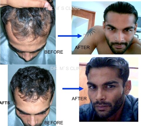 Dr. M Hair Transplant Clinic in Ambawadi - Book Appointment Online - Best Hair Treatment Clinics in Ahmedabad - Justdial Dr. M Hair Transplant Clinic in Ambawadi - Book Appointment Online - Best Hair Treatment Clinics in Ahmedabad - Justdial