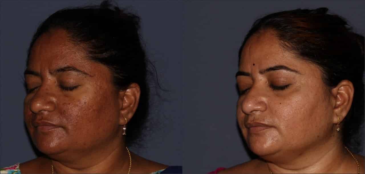 Top Skin Polishing Doctors in Kashti, Ahmednagar Best Skin