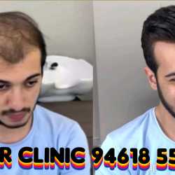 Us Hair Clinic in Ajmer Club Chowk,Ajmer - Book Appointment Online - Best Clinics in Ajmer - Justdial Us Hair Clinic in Ajmer Club Chowk,Ajmer - Book Appointment Online - Best Clinics in Ajmer - Justdial