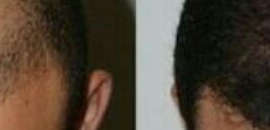 Hair Transplant Gone Wrong Hair Loss Cure 2020
