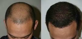 Hair Transplant Gone Wrong Hair Loss Cure 2020