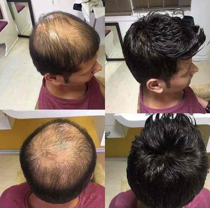 Top Hair Fixing Services In Rangaswamy Nagar Anantapur Hair