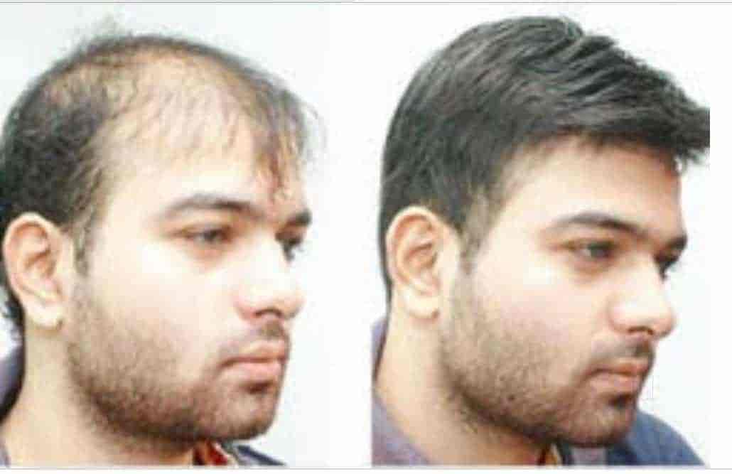 Top 20 Hair Transplant Clinics In M G Road Bangalore Best Hair