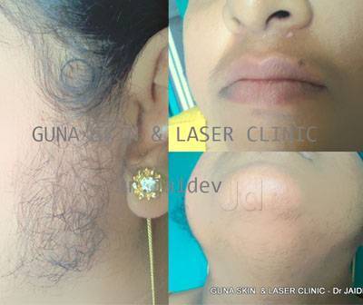 Guna Skin And Laser Clinic (Closed Down) in Kumara Park West,Bangalore - Best in Bangalore - Justdial Guna Skin And Laser Clinic (Closed Down) in Kumara Park West,Bangalore - Best in Bangalore - Justdial