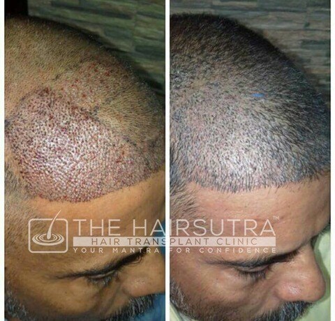The Hairsutra Hair Transplant Clinic in Koramangala 4th Block,Bangalore - Best Hair Treatment Clinics in Bangalore - Justdial The Hairsutra Hair Transplant Clinic in Koramangala 4th Block,Bangalore - Best Hair Treatment Clinics in Bangalore - Justdial