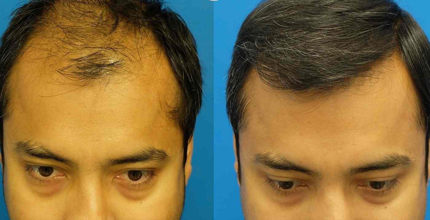 Neo Follicle Hair Transplant  Bangalore