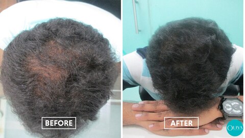 Oliva Skin And Hair Clinic in Vyalikaval,Bangalore - Best Beauty Clinics For Hair Removal in Bangalore - Justdial Oliva Skin And Hair Clinic in Vyalikaval,Bangalore - Best Beauty Clinics For Hair Removal in Bangalore - Justdial