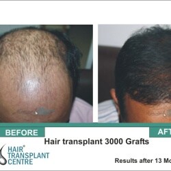 Rejuvenate Hair Transplant Centre in Kasturba Nagar - Best Hair Transplant Clinics in Bhopal - Justdial Rejuvenate Hair Transplant Centre in Kasturba Nagar - Best Hair Transplant Clinics in Bhopal - Justdial