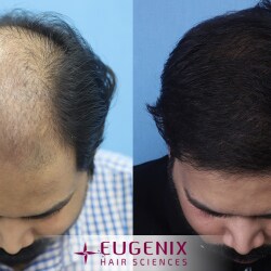 Cosmo World Clinic - Hair Patching