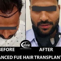CABELO Best Hair Transplant Clinic in Gangashahar Bikaner Best