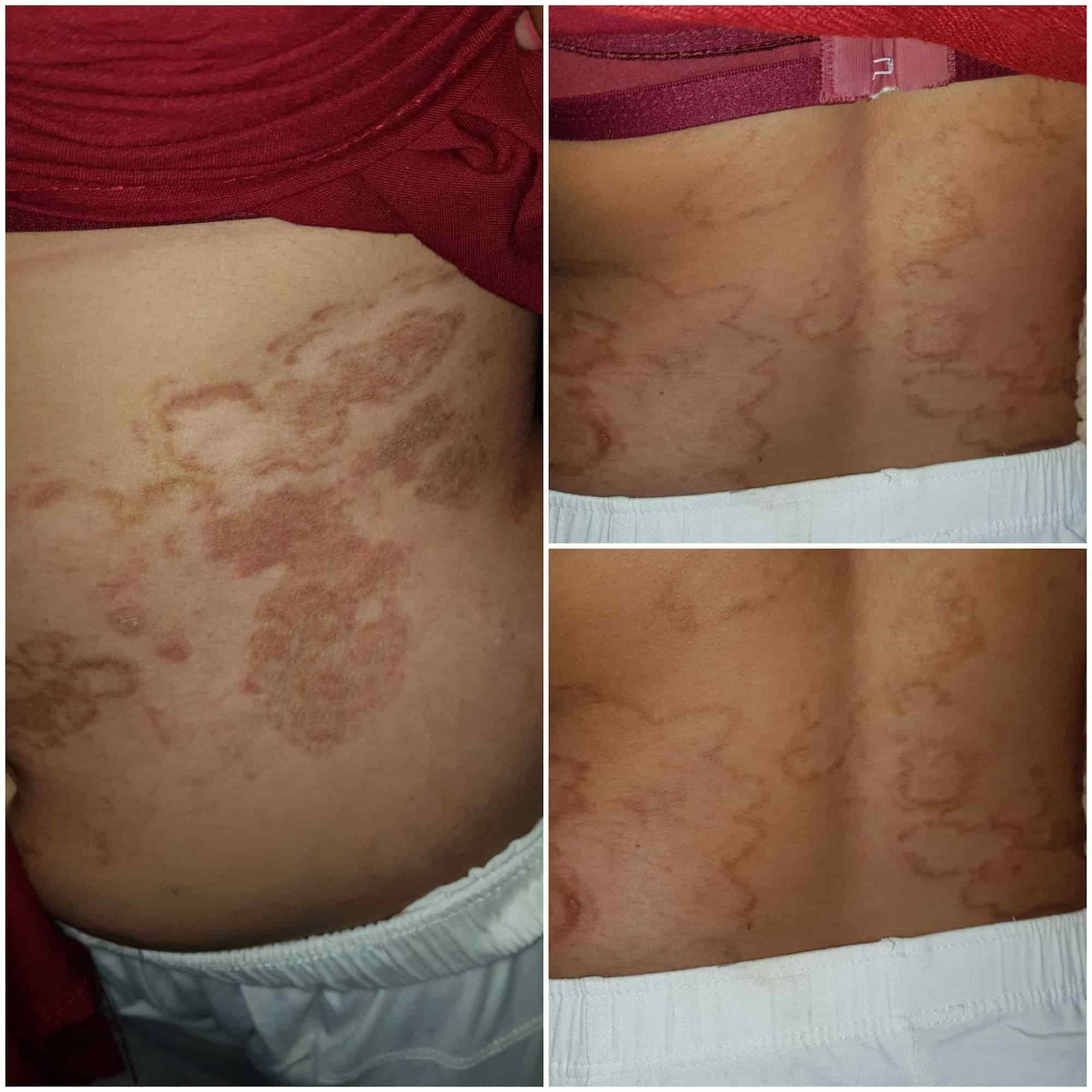 Dr Vikas SharmaLaser Care Clinic Skin Hair Cosmetic & Laser in Ring