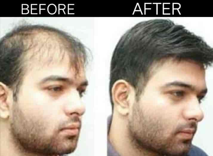Top Hair Clinics In Bokaro Best Trichologists Justdial