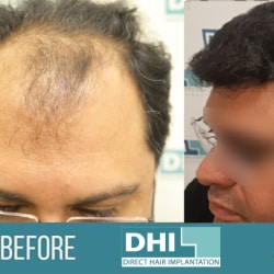 Aggregate 140+ hair transplant in khanna latest