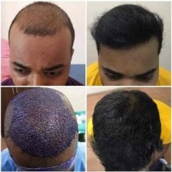 Guru Hairtransplant in Near Vip Road - Best Hair Transplant Clinics in Chandigarh - Justdial Guru Hairtransplant in Near Vip Road - Best Hair Transplant Clinics in Chandigarh - Justdial