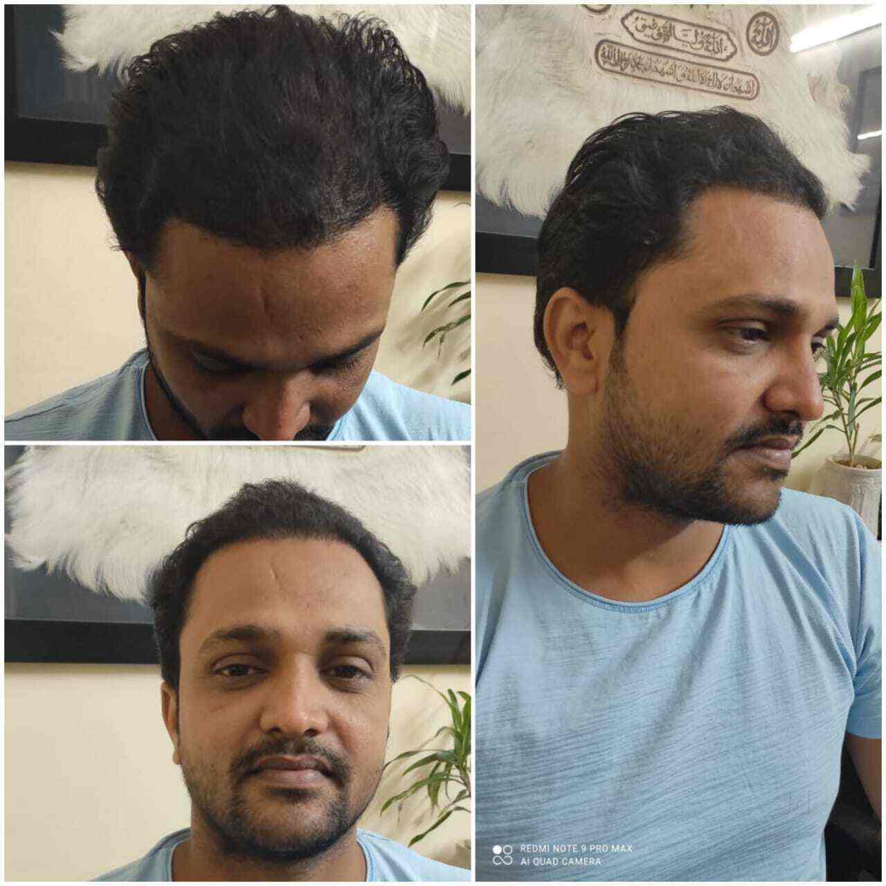 Top Prp Hair Transplantation Treatment Doctors in Greater Noida, Delhi
