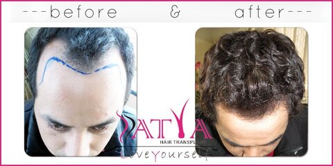 Satya Skin Laser Hair Transplant Clinic in Prem Nagar - Book Appointment Online - Best Beauty Clinics in Delhi - Justdial Satya Skin Laser Hair Transplant Clinic in Prem Nagar - Book Appointment Online - Best Beauty Clinics in Delhi - Justdial