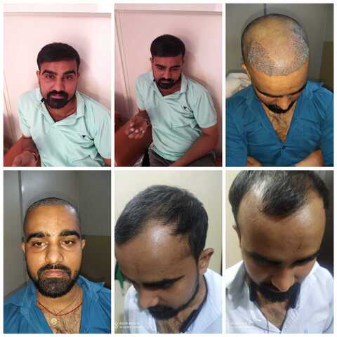 Kaka Hair Transplant Clinic in Pataudi Chowk,Delhi - Best Hair Transplant Doctors in Delhi - Justdial Kaka Hair Transplant Clinic in Pataudi Chowk,Delhi - Best Hair Transplant Doctors in Delhi - Justdial