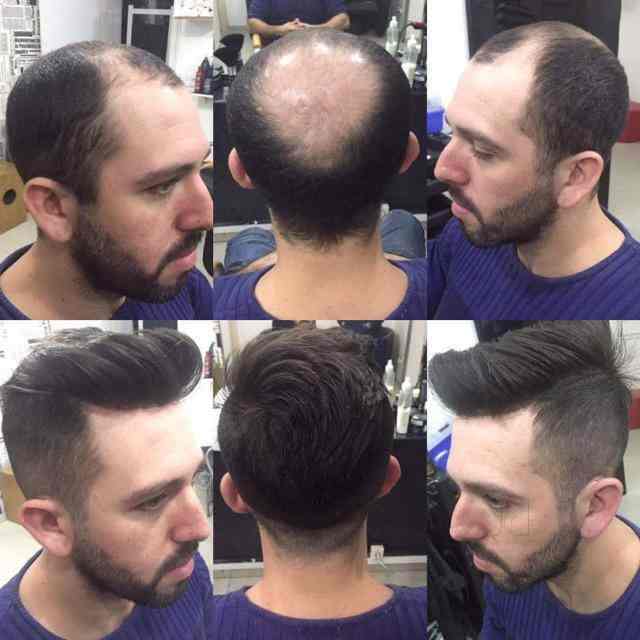 Top Hair Weaving Services In Gurgaon Delhi Fix Your Baldness