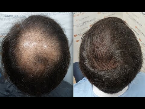 PARRY'S ADVANCED HAIR TRANSPLANT AND SKIN CLINIC in Ranhola - Best Skin Care Clinics in Delhi - Justdial PARRY'S ADVANCED HAIR TRANSPLANT AND SKIN CLINIC in Ranhola - Best Skin Care Clinics in Delhi - Justdial