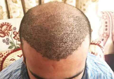 Dermawave Pvt Ltd in Rohini Sector 19 - Book Appointment Online - Best Hair Transplant Doctors in Delhi - Justdial Dermawave Pvt Ltd in Rohini Sector 19 - Book Appointment Online - Best Hair Transplant Doctors in Delhi - Justdial
