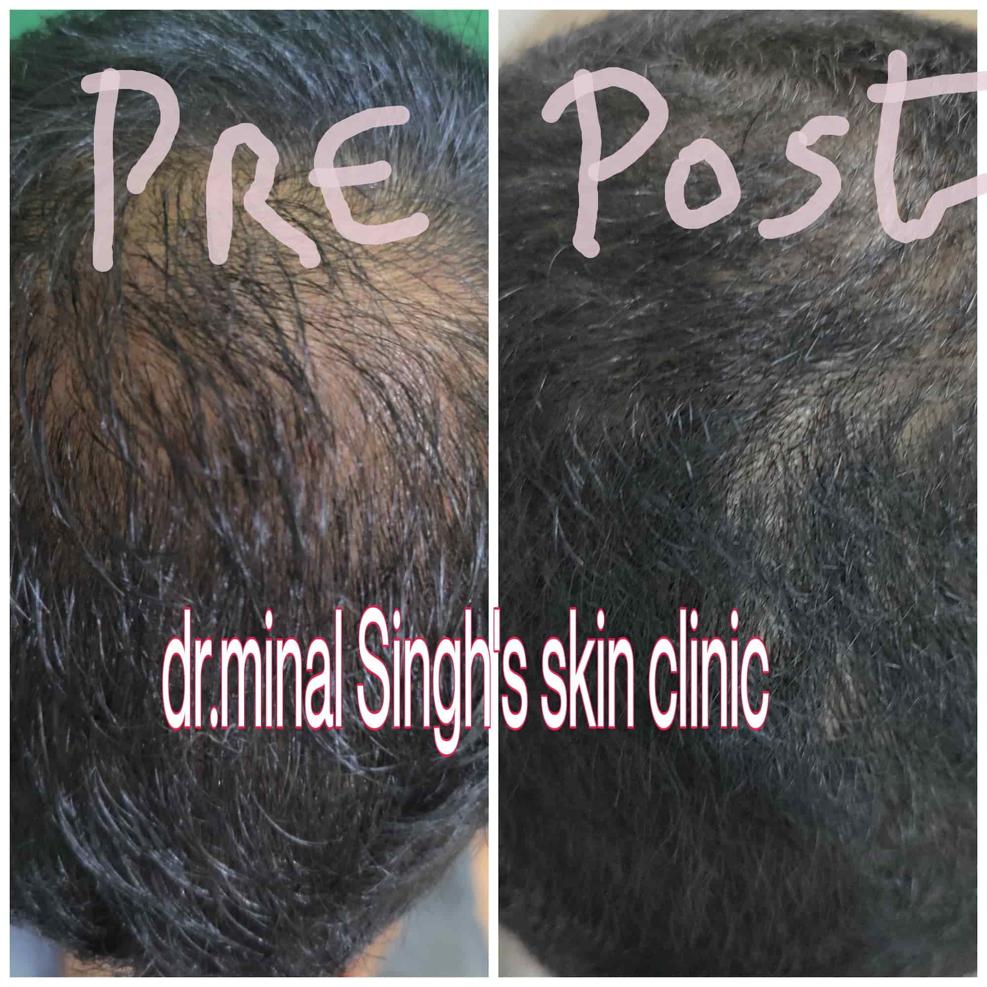 Dr. Minal Singh'S Skin in Kalani Bagh,Dewas Best Dermatologists in