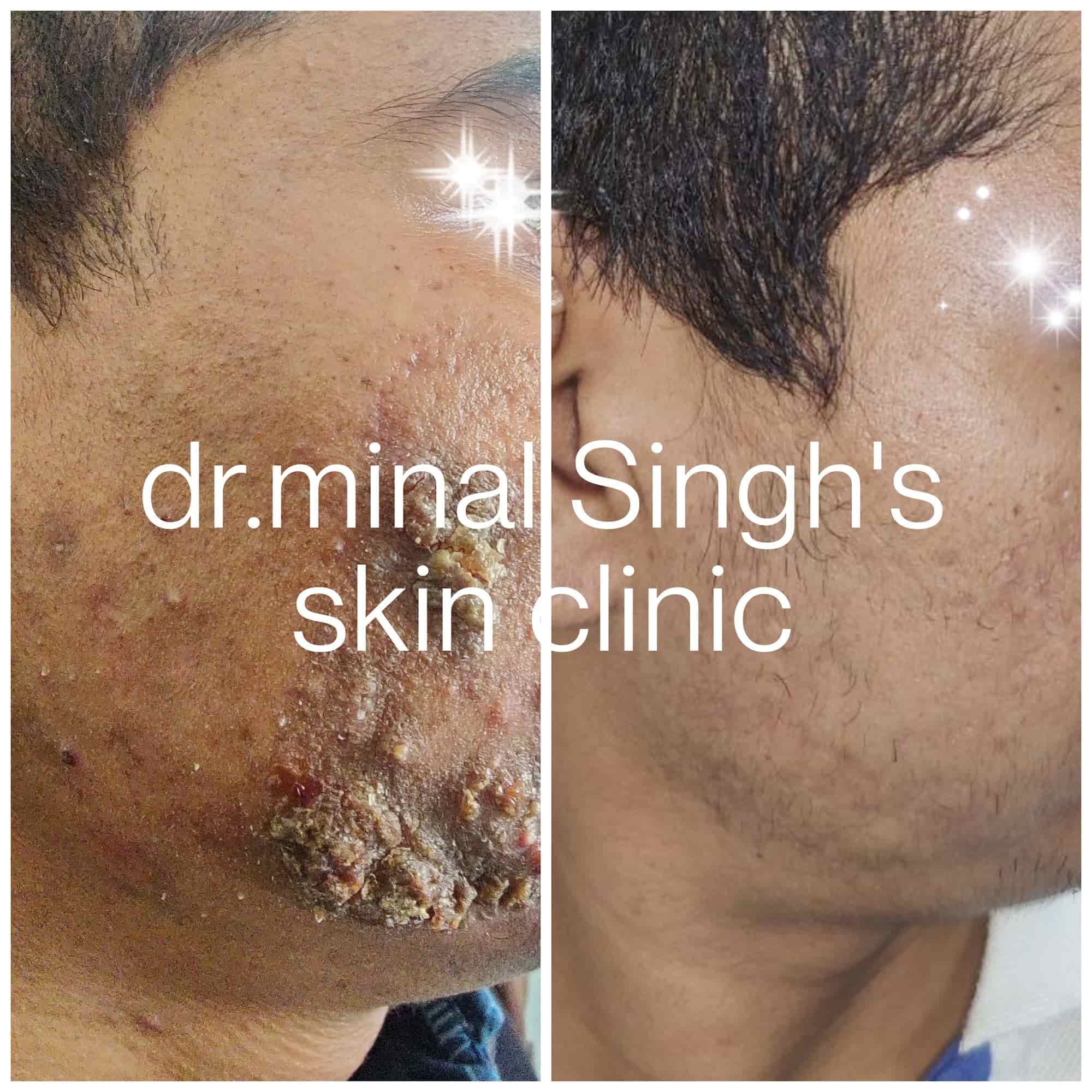 Dr. Minal Singh'S Skin in Kalani Bagh,Dewas Best Dermatologists in