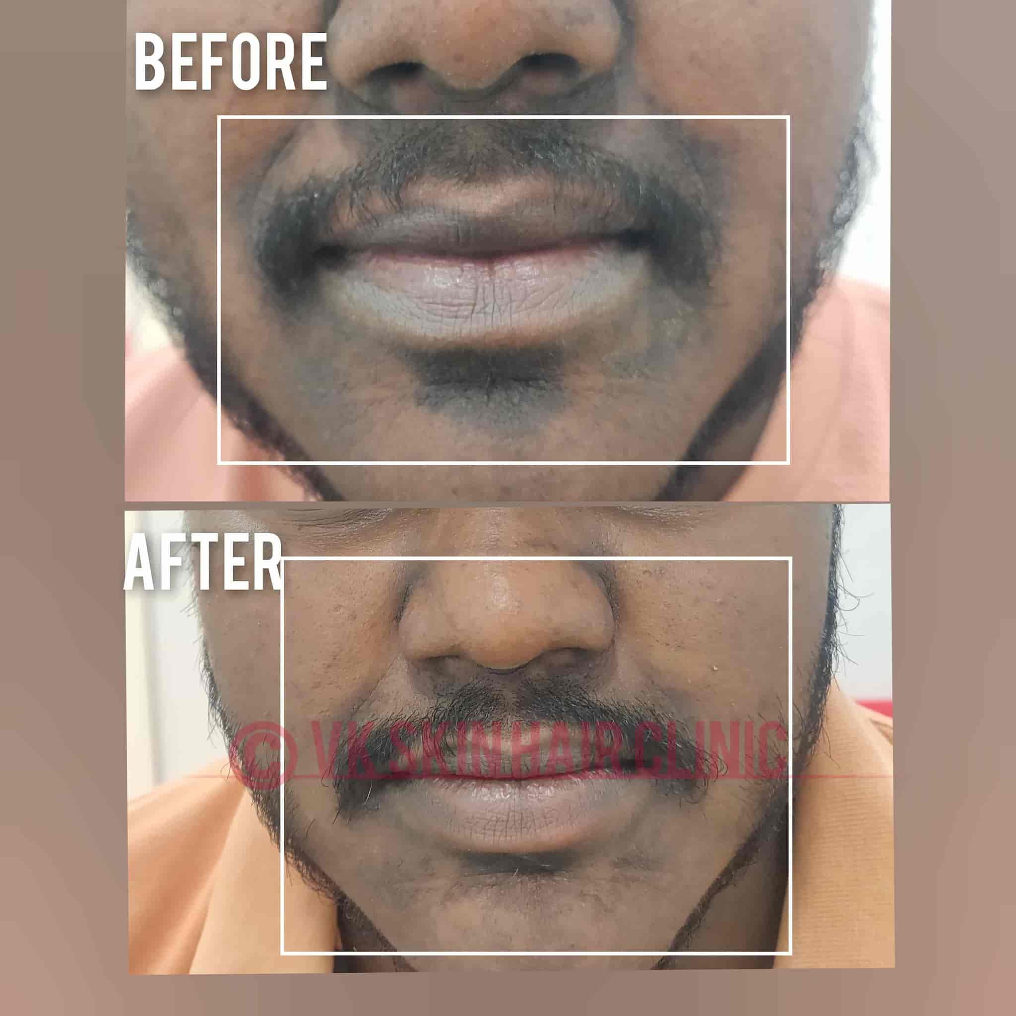 Top Eczema Treatment in Trichy Best Dermatologistseczema Treatment