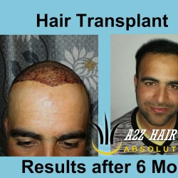 A 2 Z Hair Trannsplant Clinic in Dasna,Delhi - Best Hair Treatment Clinics in Delhi - Justdial A 2 Z Hair Trannsplant Clinic in Dasna,Delhi - Best Hair Treatment Clinics in Delhi - Justdial