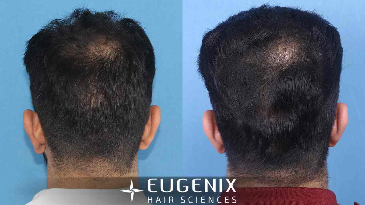 Aggregate more than 100 eugenix hair transplant cost latest ceg.edu.vn