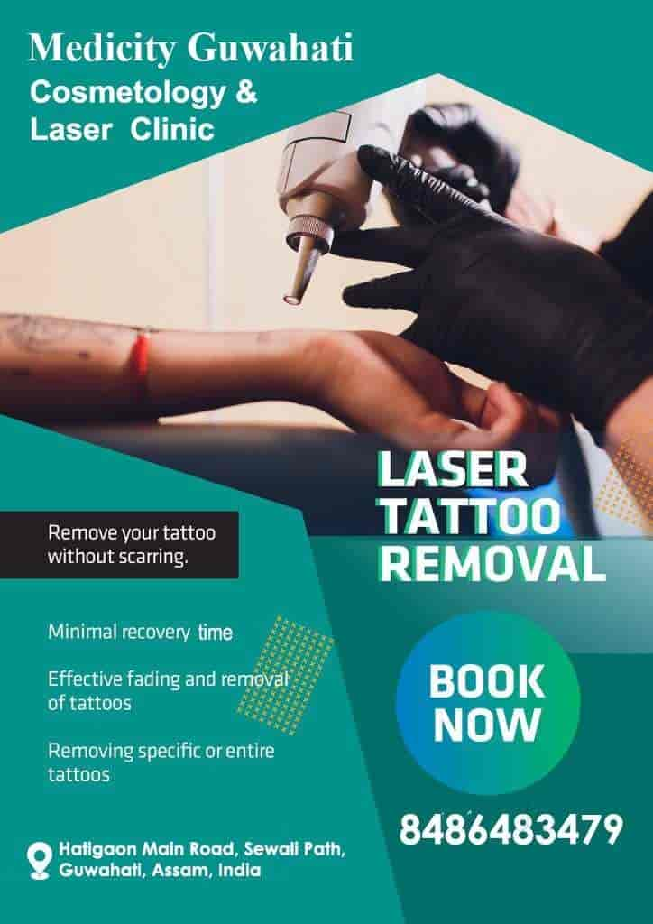 Permamant Laser Tattoo Removal Treatment Clinic in Gurgaon Near me at  Affordable Cost With Best Doctor