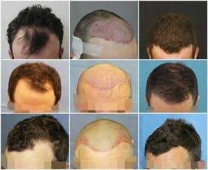 Vcare Super Speciality Hair Clinic in Banjara Hills,Hyderabad - Best Hair Treatment Clinics in Hyderabad - Justdial Vcare Super Speciality Hair Clinic in Banjara Hills,Hyderabad - Best Hair Treatment Clinics in Hyderabad - Justdial
