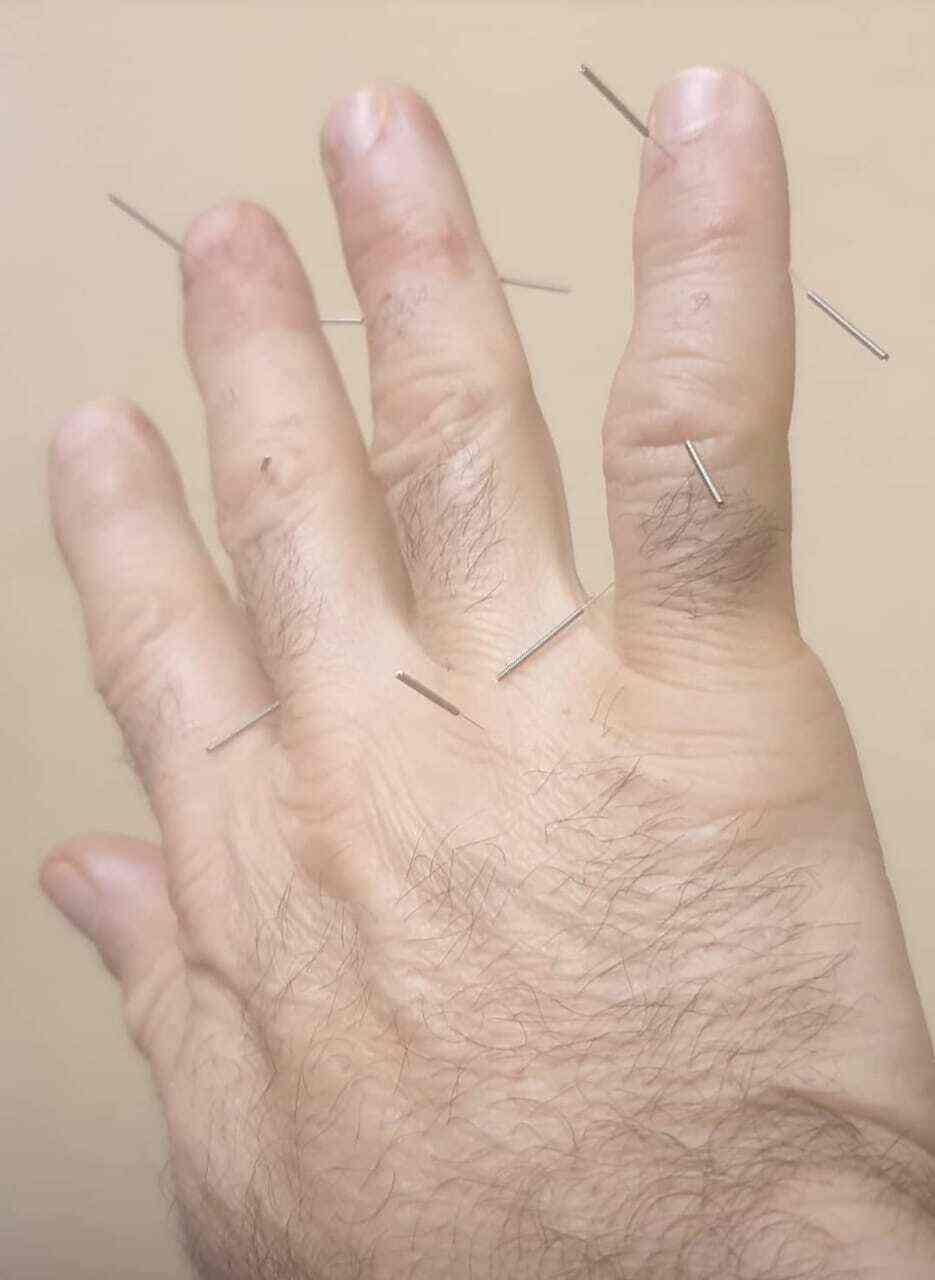 List Of Best Acupuncture Doctors in Ameerpet Best Acupuncture Clinics