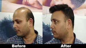 hair-patch-fixing-and-services-saroor-nagar-hyderabad hair-patch-fixing-and-services-saroor-nagar-hyderabad