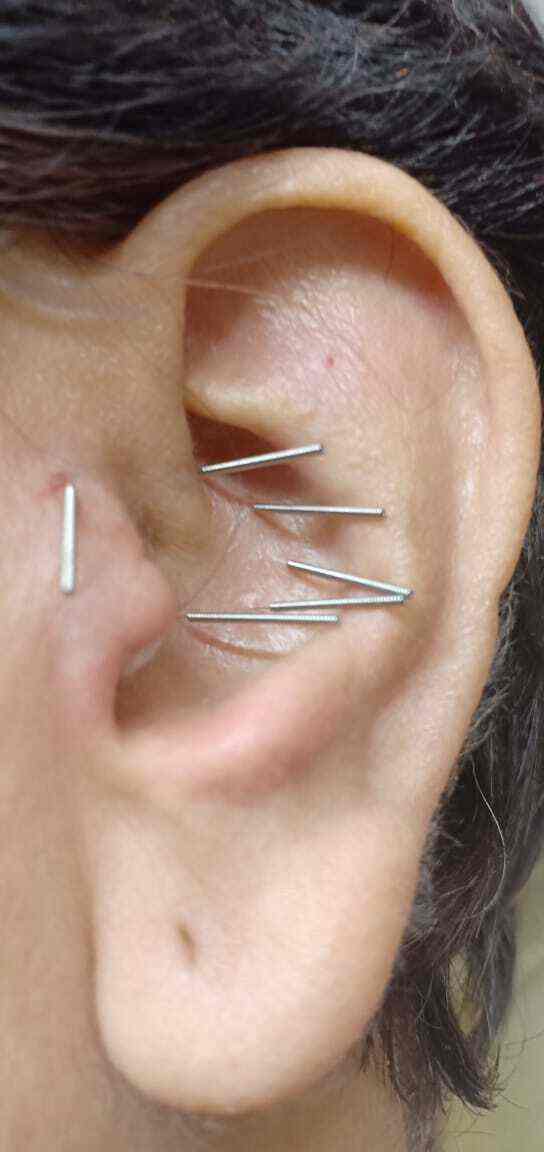 Sujok Therapy Center in Nallagandlaserilingampally,Hyderabad Best