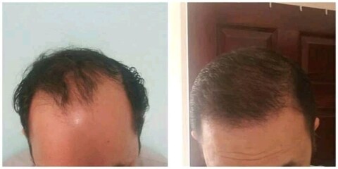 Scala Skin and Hair Transplant Clinic in Kukatpally,Hyderabad - Book Appointment Online - Best Beauty Clinics in Hyderabad - Justdial Scala Skin and Hair Transplant Clinic in Kukatpally,Hyderabad - Book Appointment Online - Best Beauty Clinics in Hyderabad - Justdial