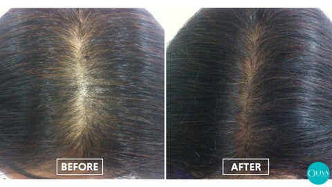 Oliva Clinic in Kukatpally - Best Laser Hair Removal Treatment in Hyderabad - Justdial Oliva Clinic in Kukatpally - Best Laser Hair Removal Treatment in Hyderabad - Justdial