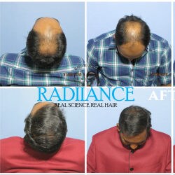Radianceadvanced Hair Transplant Center in Ameerpet - Best Hair Treatment Clinics in Hyderabad - Justdial Radianceadvanced Hair Transplant Center in Ameerpet - Best Hair Treatment Clinics in Hyderabad - Justdial