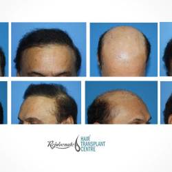 Rejuvenate Hair Transplant & Cosmetic Surgery Centre in New Palasia - Best Dermatologists in Indore - Justdial Rejuvenate Hair Transplant & Cosmetic Surgery Centre in New Palasia - Best Dermatologists in Indore - Justdial
