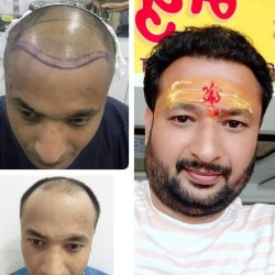 Bella Skin and Laser Clinic Hair Transplant Center in Sneh Nagar,Indore - Best Dermatologists in Indore - Justdial Bella Skin and Laser Clinic Hair Transplant Center in Sneh Nagar,Indore - Best Dermatologists in Indore - Justdial