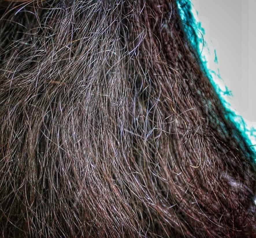 Follicle Hair Clinic & Hair Transplant Center in C Scheme,Jaipur Best