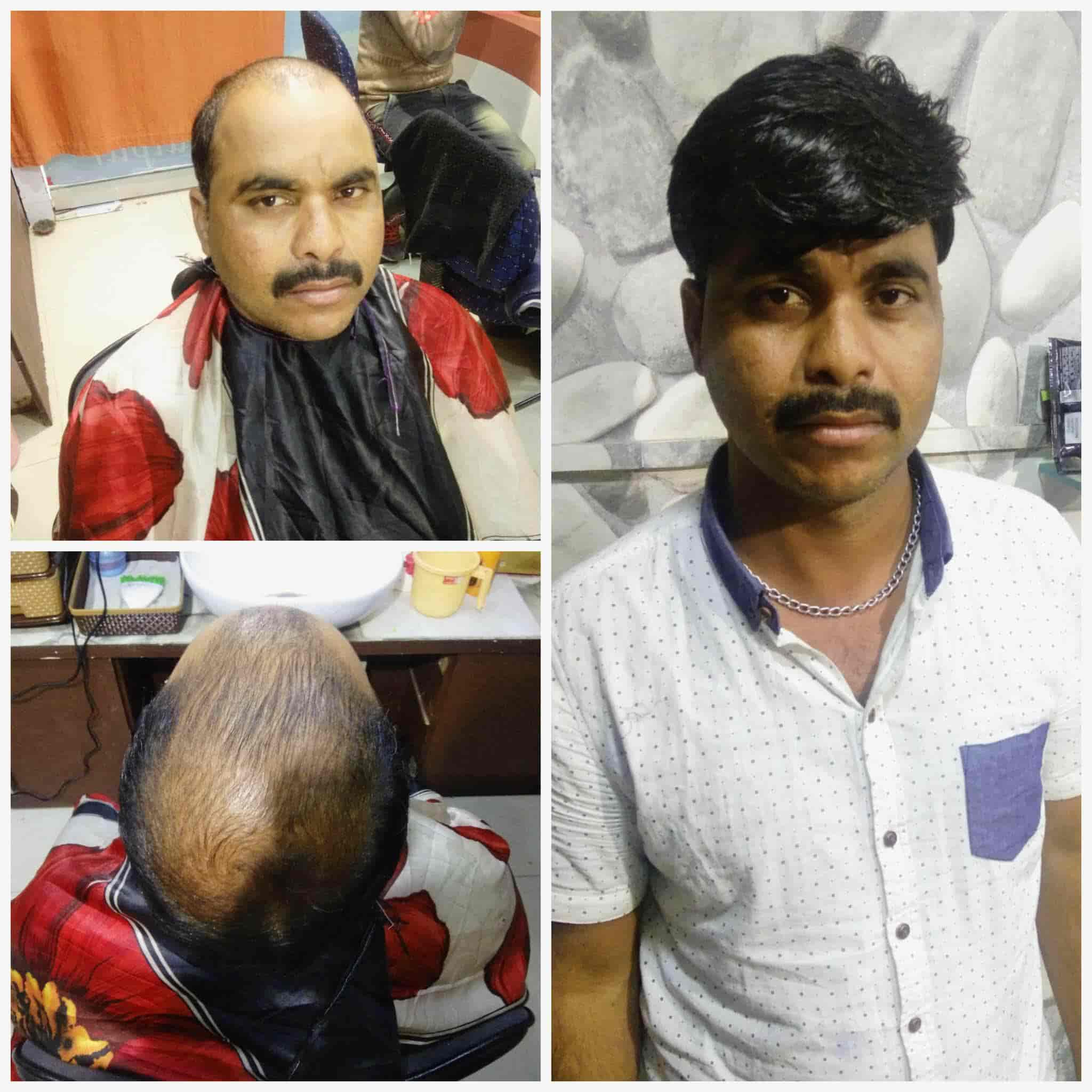 Update 125+ hair patch in jaipur latest camera.edu.vn