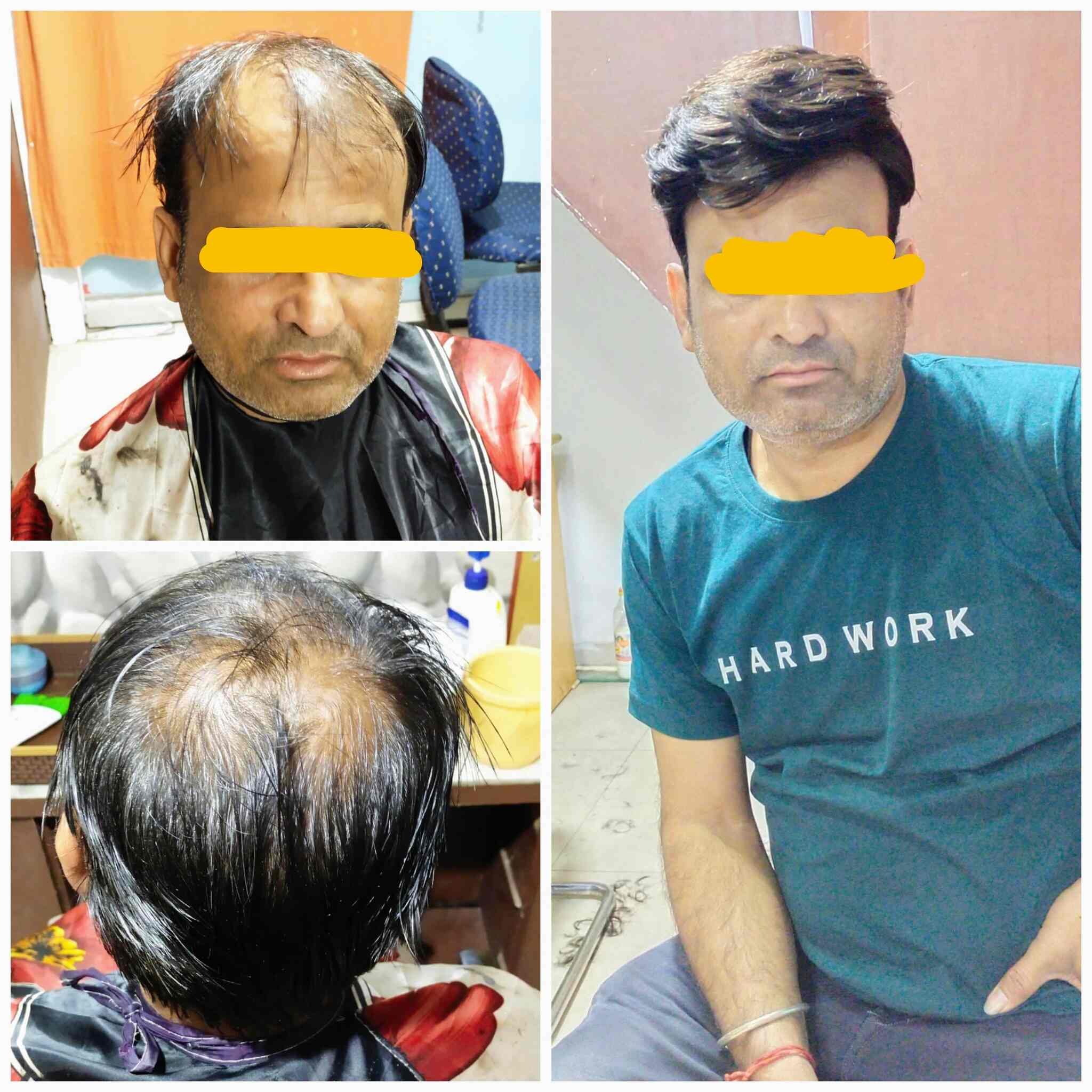 Share 134+ hair wig in jaipur super hot ceg.edu.vn