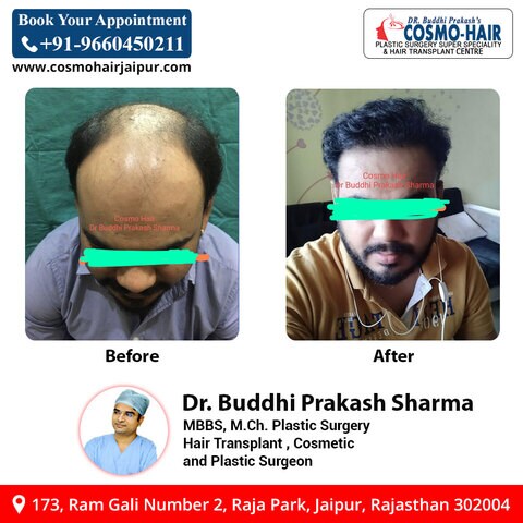 Cosmo Hair Plastic Surgery Super Speciality & Hair Transplant Centre in Raja Park,Jaipur - Best Hair Treatment Clinics in Jaipur - Justdial Cosmo Hair Plastic Surgery Super Speciality & Hair Transplant Centre in Raja Park,Jaipur - Best Hair Treatment Clinics in Jaipur - Justdial