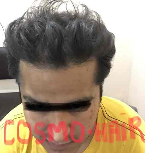 Cosmo Hair Plastic Surgery Super Speciality Hair Transplant Centre Photos, Raja Park, Chandigarh- Pictures & Images Gallery - Justdial Cosmo Hair Plastic Surgery Super Speciality Hair Transplant Centre Photos, Raja Park, Chandigarh- Pictures & Images Gallery - Justdial