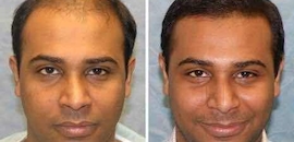 Hair Loss Cure