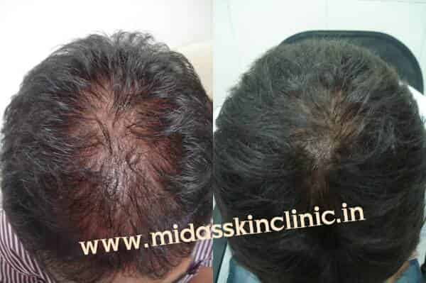 Midas Skin Laser and Hair Transplant Centre Photos, Shastri Nagar, Jodhpur- Pictures & Images Gallery - Justdial Midas Skin Laser and Hair Transplant Centre Photos, Shastri Nagar, Jodhpur- Pictures & Images Gallery - Justdial