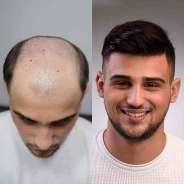 Top Hair Weaving Services In Jodhpur Fix Your Baldness Justdial