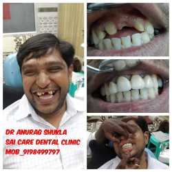 How To Handle Every front tooth composite fillings Challenge With Ease Using These Tips