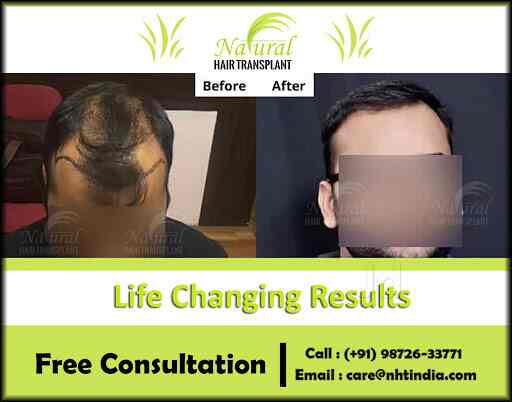 Top Fue Hair Transplant Doctors in Kanpur - Best Follicular Hair Transplant Treatments - Book Appointment Online - Justdial Top Fue Hair Transplant Doctors in Kanpur - Best Follicular Hair Transplant Treatments - Book Appointment Online - Justdial